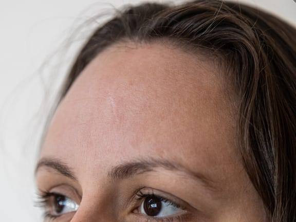 Scalp Micropigmentation hairline definition (1)