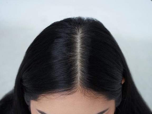 Non-Surgical Scalp Rejuvenation hairline definition (15)