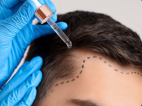 Non-Surgical Scalp Rejuvenation hairline definition (16)