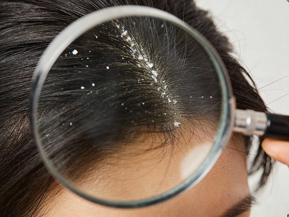 Dandruff & Scalp Condition Management hairline definition (19)
