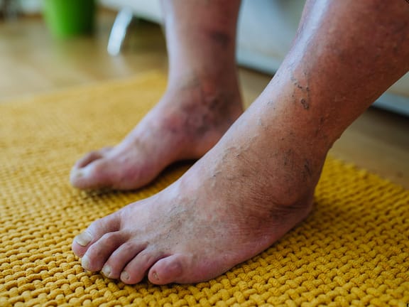 Neuropathy hairline definition 2026 01 05t133016.390