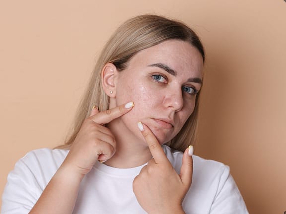 Hormonal Imbalance hairline definition 2026 01 05t144313.453