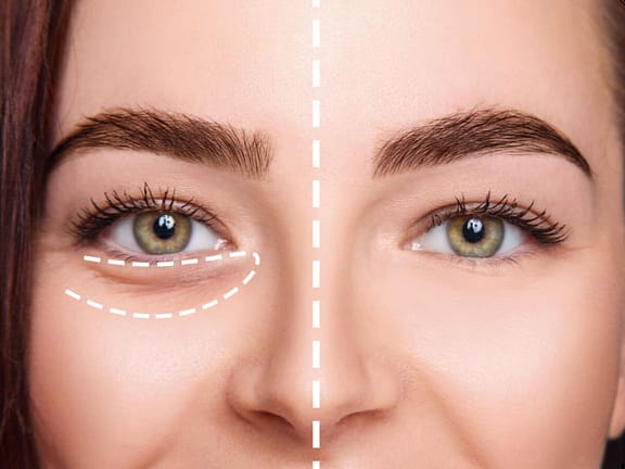 Tear Trough Correction hairline definition 2026 01 06t103103.875
