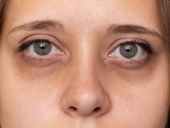 Tear Trough Correction hairline definition 2026 01 06t103241.505