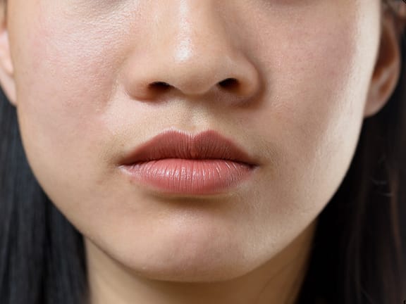 Nasal Ala Correction (Non-Surgical) hairline definition 2026 01 06t104457.483