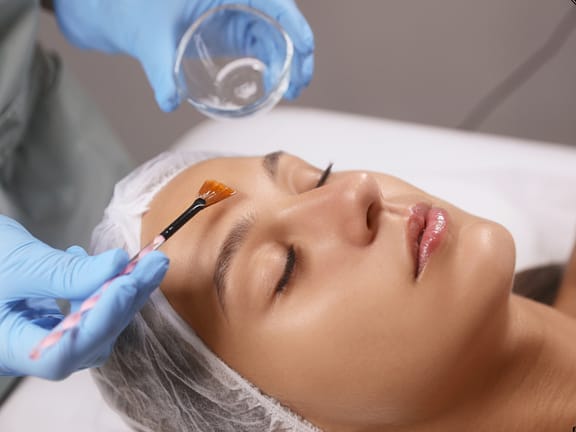 Chemical Peels hairline definition 2026 01 06t111322.238
