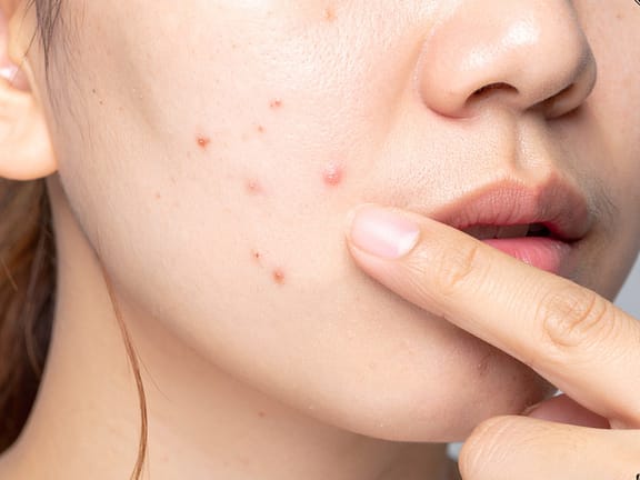 Chemical Peels hairline definition 2026 01 06t111348.590