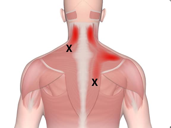 Trigger Point Injections hairline definition 2026 01 06t123305.568