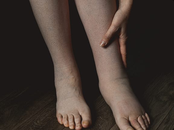 Lymphedema Therapy hairline definition 2026 01 06t131957.825