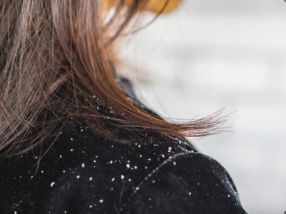 Dandruff & Scalp Condition Management hairline definition (21)