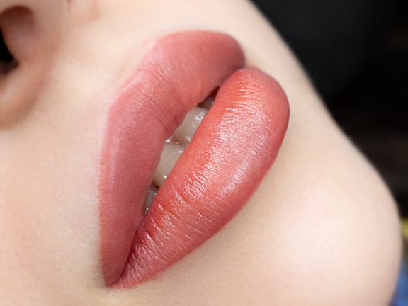 Lip Filler hairline definition (26)