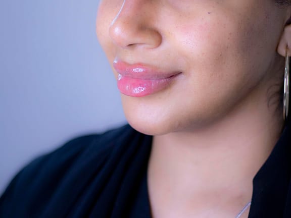 Dermal Filler hairline definition (35)