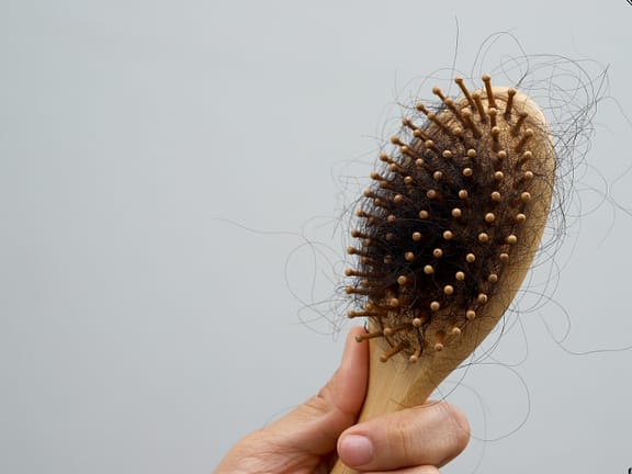 Hair Loss hairline definition (39)