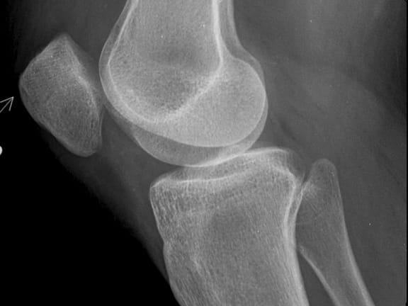 Joint Pain hairline definition (63)