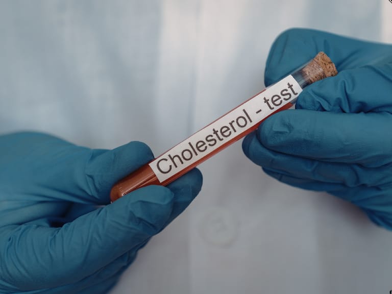 High Cholesterol hairline definition (93)